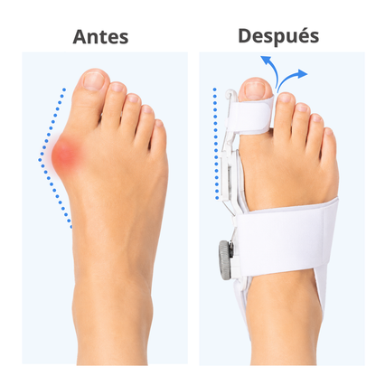 Alivio del Dolor y Corrector de Juanete